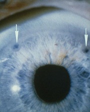 Операция глаукомы в пскове